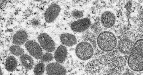 Monkeypox virus. Photo courtesy of the Centers for Disease Control.