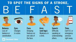This infographic shows signs of a stroke. If you or someone you know has even one of these symptoms, call 911. BE FAST. (Cleveland Clinic infographic)